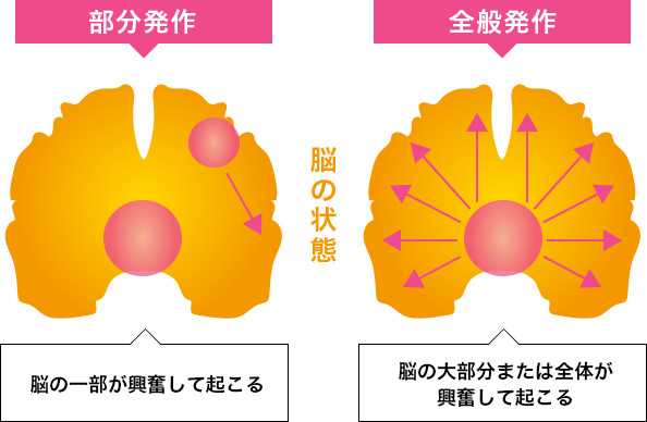 てんかんの検査と治療